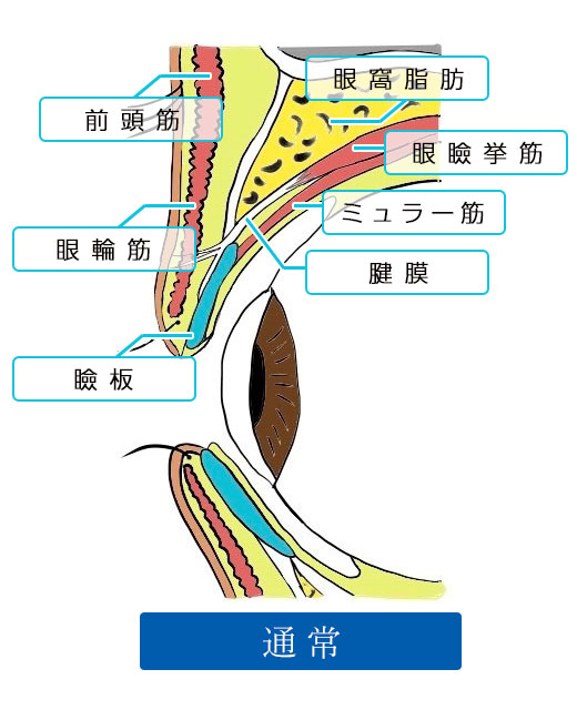 眼瞼下垂症手術（挙筋腱膜前転術）：通常