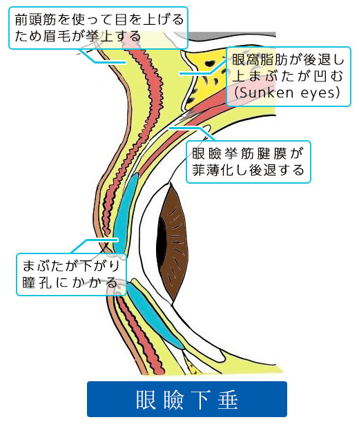 眼瞼下垂症手術（挙筋腱膜前転術）：眼瞼下垂