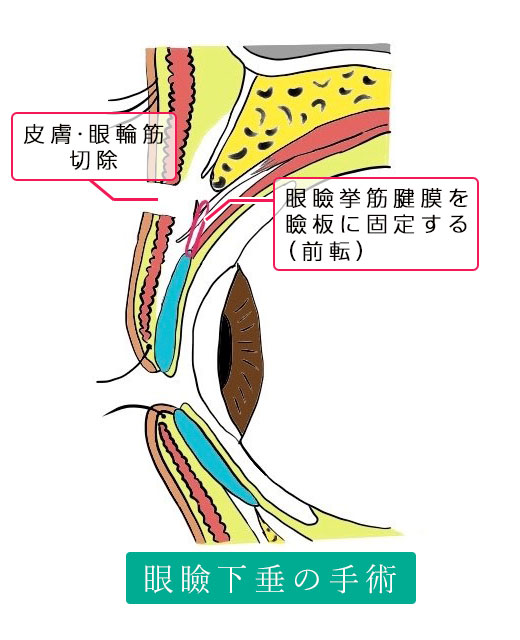 眼瞼下垂症手術（挙筋腱膜前転術）：眼瞼下垂の手術